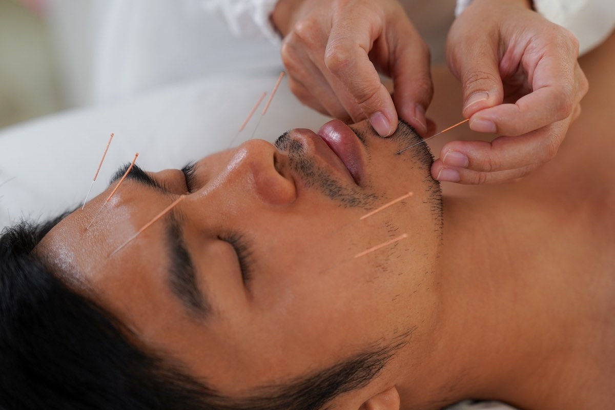 man receiving acupuncture